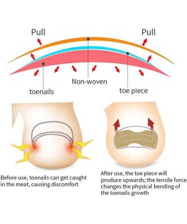 CheeseandU 2022 Ingrown Toenail Stickers 10-Pack - Glue-Free Toe Nail Patch for Painless Correction - Men & Women Toenail Care - Buy Online on GoSupps.com