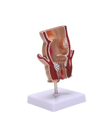 Hemorrhoid Lesion Model Human Rectal Pathological Anatomy Model Internal Model of Hemorrhoids External Model of Hemorrhoids Anal Model Tool Teaching