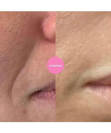 Notox Mouth + Smile Lines - Nudie Face 100% Medical Grade Silicone Wrinkle Patches | Reusable Silicone Patches To Reduce Mouth and Smile Lines | Fine Line & Wrinkle Reduction | Fast Results - Buy Online on GoSupps.com