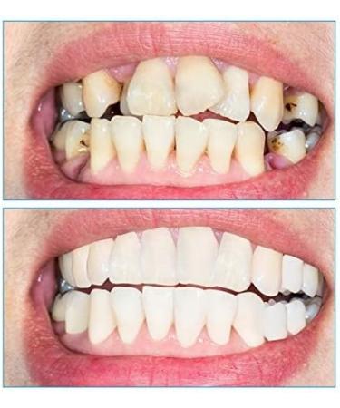 Buy WTTFC Couples False Teeth Veneers | Cosmetic Provisional Dentures for Men & Women - International Shipping - Buy Online on GoSupps.com