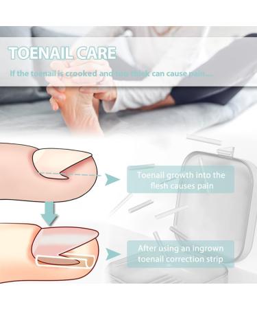 KINDOYO Correction Ingrown Toenails Set - 40 Pieces Painless Toenail Smoothing Strips with Toenail Lifter - Simple Tool Set for Ingrown Toenails - Buy Online on GoSupps.com