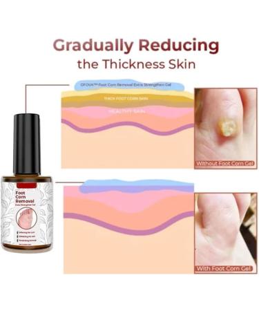 GFOUK Extra Strength Gel Corn Remover - Fast Acting Corn Removal for Feet, Toes, and Hands (4PCS) - Buy Online on GoSupps.com