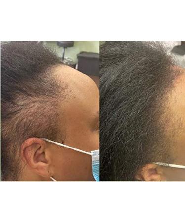 Infinix 2 BOTTLE COMBO Thick Black Rice Oil for Hair Growth with Biotin & Peppermint - Buy Online on GoSupps.com