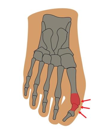 Fu Gut Hallux Valgus Protector - 2 Pairs Universal Size | Comfort & Pain Relief for Foot Health - Buy Online on GoSupps.com