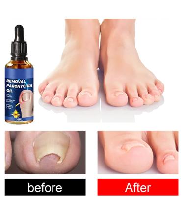 3Pcs German Toenailcare Removal Paronychia Oil for Healthier Toenails - Buy Online on GoSupps.com