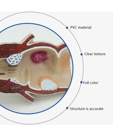 Humanly Rectal Hemorrhoid Lesions Anatomical Model Dilkpunkt Anal Anorectal - Buy Online on GoSupps.com