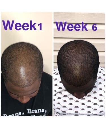 MKKENLEY Ginger Anti Hair Loss Shampoo & Conditioner Set - Hair Growth Treatment for Men & Women - Nourishes Scalp, Promotes Hair Regrowth - 300ml - Buy Online on GoSupps.com