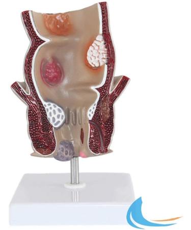 Rectum Model Human Pathological Diseases Rectum Ulcus Acne Pathological Model Use for Model Hemorrhoid Model Demonstration of Anorectal Diseases - Buy Online on GoSupps.com