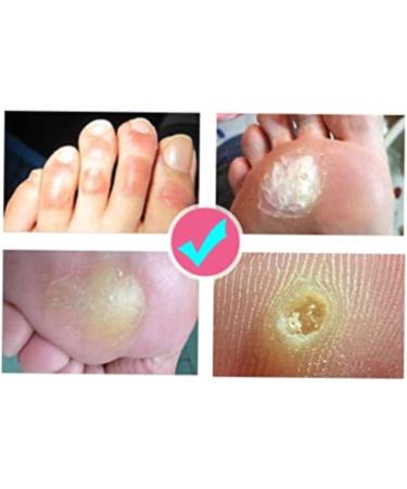 Foot Callus Treatment Kit - Callus Remover Cream, Corn Pad, Toe Protector, Blister Plaster & Balm for Pain-Free Feet - Buy Online on GoSupps.com