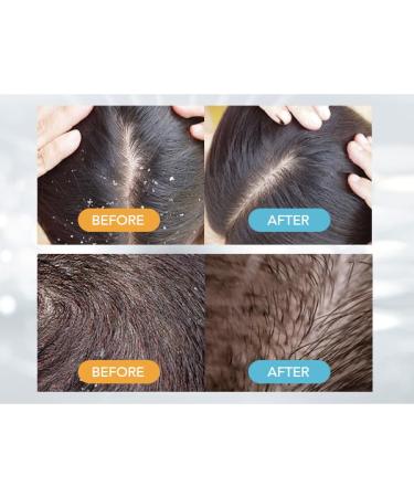 Ketoconazole Shampoo Kit | 1% Dandruff Treatment for Itchy Scalp & Psoriasis | 8.4oz Scalp Relief & Dermatitis Care - Buy Online on GoSupps.com