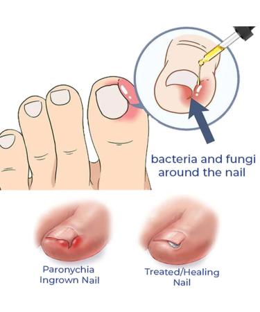 German ToenailPlus Anti Paronychia Relief Oil - Repair Damaged Nails (2 Pcs) - Buy Online on GoSupps.com