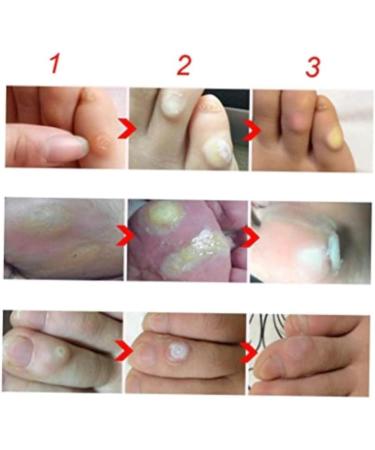 Foot Callus Treatment Kit - Callus Remover Cream, Corn Pad, Toe Protector, Blister Plaster & Balm for Pain-Free Feet - Buy Online on GoSupps.com