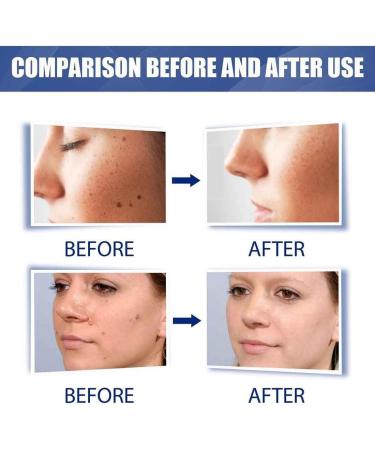 Wartsoff Instant Blemish Cream Wart Remover Cream Safe Natural Extract Wart Remover Ointment Warts Remover Wart Removal Ointment Against Warts - Buy Online on GoSupps.com