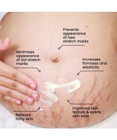 Thrive.Co Stretch Marks Expert Serum Cream | Remove Red & White Stretch Marks | Hydrating Formula with Striover Rosehip Oil & Squalane | Unisex | 30ml - Buy Online on GoSupps.com