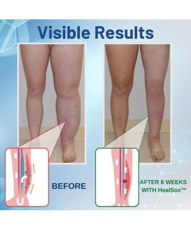 Healsox Anti-Edema Compression Socks - Tourmaline Self-Heating & Magnetic Foot Massage Therapy (3 Pairs) for Weight Loss & Health - International Shipping Available - Buy Online on GoSupps.com