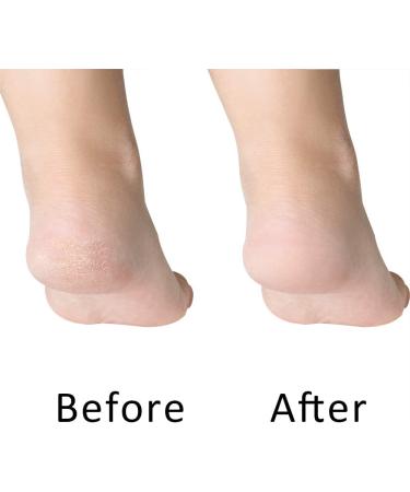 Yucool 4-Pack Foot Pumice Stone & Exfoliator Set | Callus Remover Scrubber with Stainless Steel Riper & Nail Files - Perfect Pedicure Essentials - Buy Online on GoSupps.com