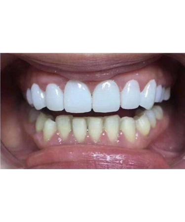 SowSmile Snap-On Smile Veneers for Instant Perfect Dental Care - Whitening Dentures - Buy Online on GoSupps.com