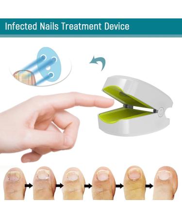 Lanlousy 905NM Nail Therapeutic Instrument Portable Painless Nail Therapy Device Anti- Silicone Easy to Use White - Buy Online on GoSupps.com