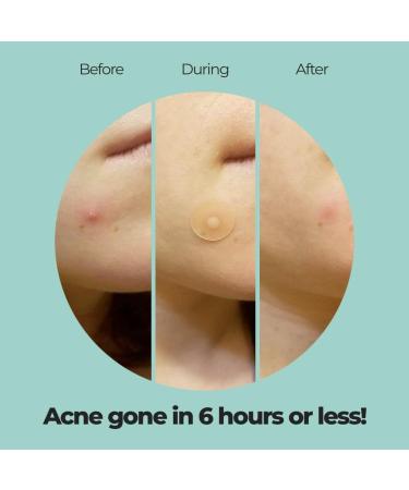 UVA Lifestyle Acne Patches Effective Pimple & Spot Treatment with Salicylic Acid | International Shipping Available - Buy Online on GoSupps.com