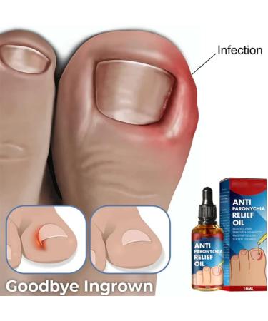 German Toenailcare Paronychia & Bunion Relief Oil for Thick, Discolored Nails - 1Pcs - Buy Online on GoSupps.com