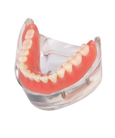Samnuerly dental model with down-implant deck prosthesis model superior 4-nail teeth demo transparent for teaching and study patient communication
