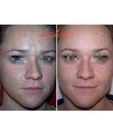 Shine Removing Soft Chemical Peel - Azelaic & Salicylic Acid Face Peel 1.69oz | Best pH3 Exfoliant for Glowing Skin - Buy Online on GoSupps.com