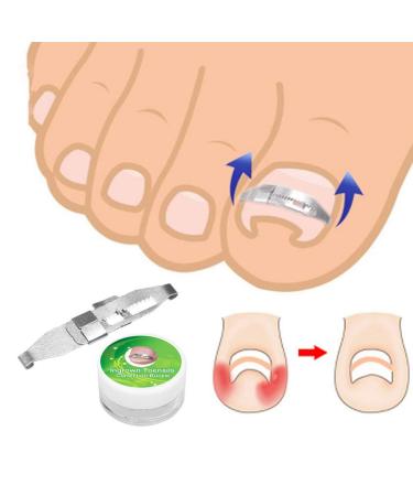Ingrown Toenail Treatment Kit for Pain Relief - Paronychia Corrector Tool Set for Salon and Home Use - Buy Online on GoSupps.com