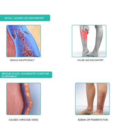 Buy Compression Stockings for Varicose Veins - Open Toe Calf Support Socks for Men & Women - Thrombosis & Weight Loss Solution - Buy Online on GoSupps.com