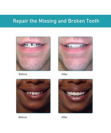 Provisional Dentures & Temporary Dental Repair Kit - Perfect for Halloween & Cosplay | Shop Now! - Buy Online on GoSupps.com