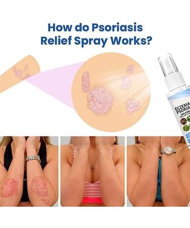BIVOO Herbal Psoriasis Relief Spray - Eczema & Vitiligo Soothing Treatment - Buy Online on GoSupps.com