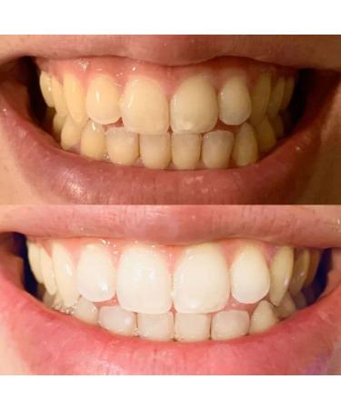 Glacier Teeth Whitening System LED Mouthpiece 3 Extra Strength Pens 16 Minute Treatment - Buy Online on GoSupps.com