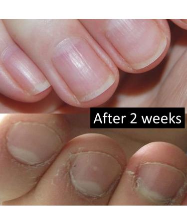 Honest 10 Nail Biting Treatment | Strongest Formula for Kids and Adults | 10-Free, Safety Tested, Dries Clear | 0.25 Ounce (Pack of 1) - Buy Online on GoSupps.com