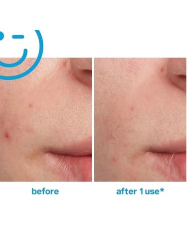 Kate Somerville EradiKate Blemish Treatment Blemish Remover Clears Blemishes Spots and Breakouts 30ml - Buy Online on GoSupps.com