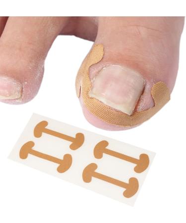 Corrector Patches Ingrown Toenail Kit Straightener Braces Curved - Buy Online on GoSupps.com
