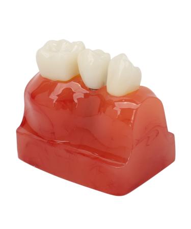 Dental implant model - 4 times enlargement demonstration model for crown bridge implant teeth - comparison of the recovery effect