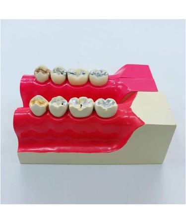Croix Dentaire Molar Section | Oral Simulation Teeth Model for Dental Study | Educational Dental Model with Nerve Line for Tissue Dissection - Buy Online on GoSupps.com