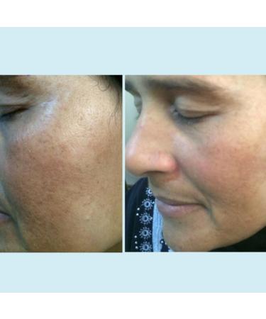 Lactic 50% Gel Peel - Chemical Exfoliant for Face Remove Breakout Scars Strength Level 2 1 oz - Perfect Image - Buy Online on GoSupps.com