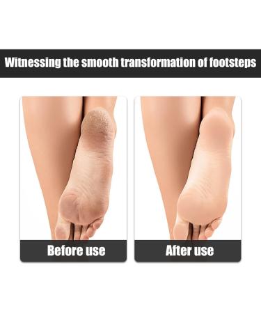 MWUMRCM Callus File Hard and Cracked Dead Skin Beautifier Professional Double Sided Callus Scraper Dead Skin Removal Tool - Buy Online on GoSupps.com