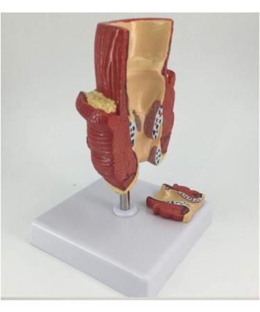 YOtat Human Pathological Hemorrhoids Model-Colorectal Hemorrhoid Lesion Model-Placed On The Base-is The Best Teaching Aid for Doctor-Patient Communication - Buy Online on GoSupps.com