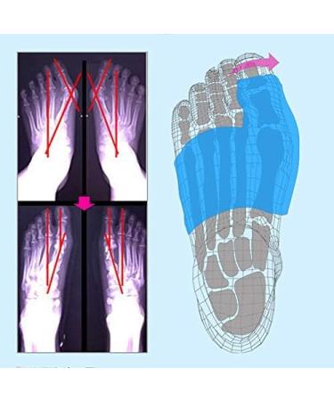 Buy Effective Bunion Corrector & Splint | Pain Relief for Hallux Valgus & Hammer Toe - International Shipping Available - Buy Online on GoSupps.com