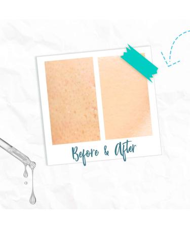 Bye Bye Blemish Skin Rescue Niacinamide Serum - Blemish-Free Skin Solution - Buy Online on GoSupps.com