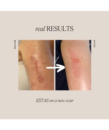 Scar Cream Treatment Set | Effective Surgical Burn C-Section & Acne Scar Solution | Vegan Cruelty-Free | Includes Vitamin E & C - 3-Product Kit - Buy Online on GoSupps.com