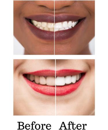 3 Professional Teeth Whitening Pens Box with 2 Carbamide Peroxide Tooth whitening Gel 1 Remineralization Made in USA (35% Whitening Gel) - Buy Online on GoSupps.com