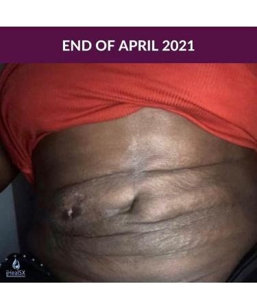 iHeal SX - SOS Serum - 2 oz (60ml) - Skin & Scar Serum - Cosmetic Surgery Scar Serum- BBL -Tummy Tuck - Breast Augmentation - Diabetic Wound Serum - Vitamin E - Buy Online on GoSupps.com