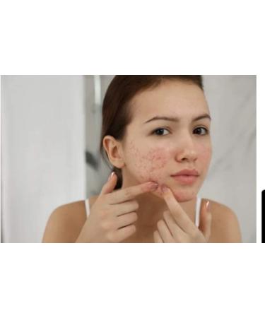 Sulphur Soap 10% Sulfur 200g Avena Sulphur Soap Rid Severe Acne Rosacea - Buy Online on GoSupps.com