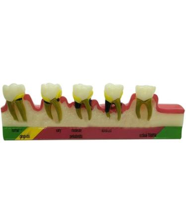 Dytah Dental Model - Adult Teeth Lessons for Periodontitis & Dental Disease Classification | Ideal for Teaching & Study - Buy Online on GoSupps.com