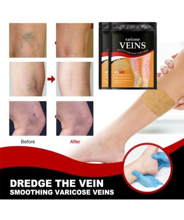 Mandurs 72Pcs Varicose Veins Patch - VeinHealth Treatment for Legs | Improve Blood Circulation, Reduce Pain & Swelling - Buy Online on GoSupps.com
