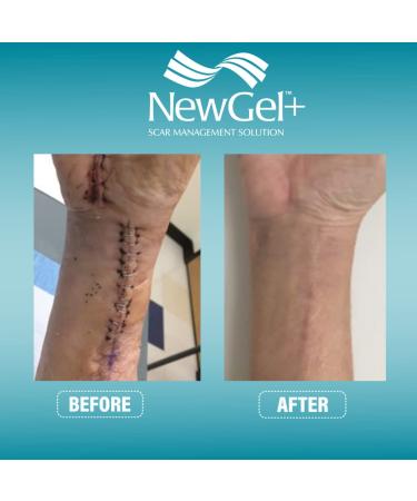 NewGel+ Advanced Silicone Scar Treatment Tape for Abdomen & Extremity - REUSABLE - Clear - Buy Online on GoSupps.com