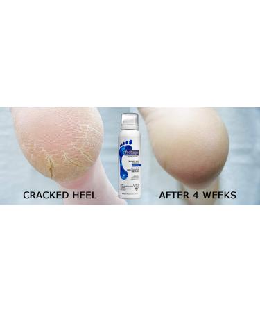 Footlogix Cracked Heel Formula 125ml - Best Treatment for Dry Cracked Heels | International Shipping Available - Buy Online on GoSupps.com