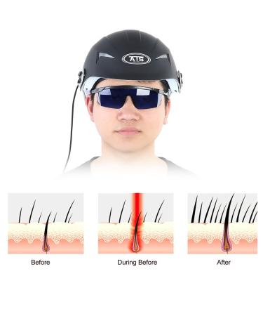 Premium Hair Growth Helmet - Alopecia Therapy with Advanced Technology for Hair Loss Prevention - Buy Online on GoSupps.com